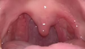 can tonsils grow back after being removed? - tymoff